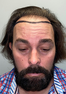 hair transplant before after Photos