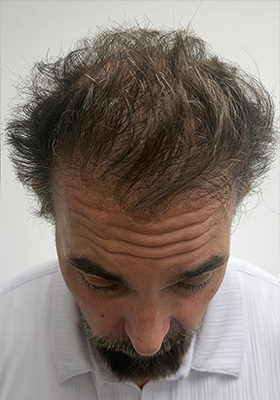 hair transplant before after Photos
