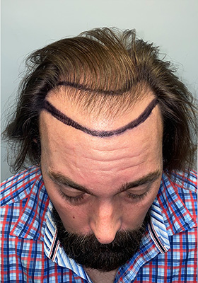 hair transplant before after Photos