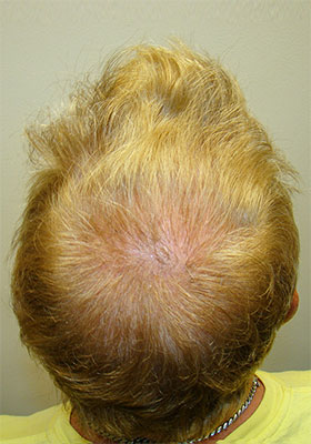 hair transplant before after Photos