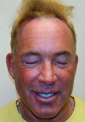 hair transplant before after Photos