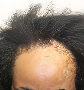 hair transplant photos