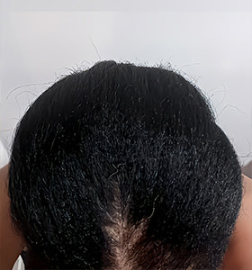 hair transplant photos