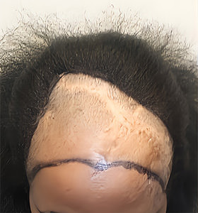 hair transplant photos