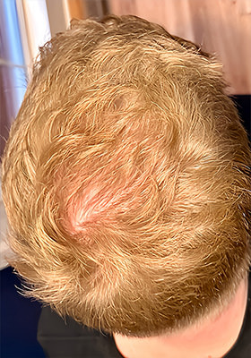 hair transplant photos