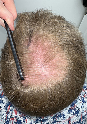 hair transplant photos