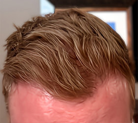 hair transplant photos