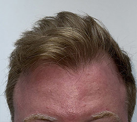 hair transplant photos