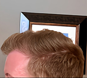 hair transplant photos