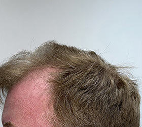 hair transplant photos