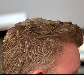 hair transplant photos