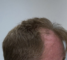 hair transplant photos