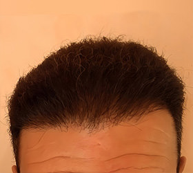 hair transplant photos