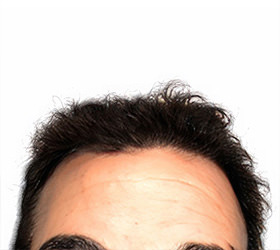 hair transplant photos