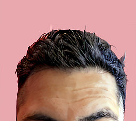 hair transplant photos