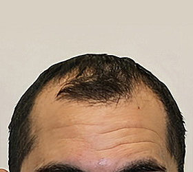 hair transplant photos