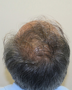 hair transplant photos