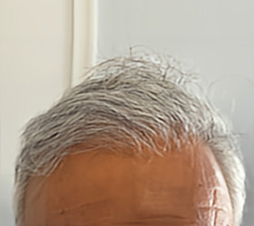 hair transplant photos