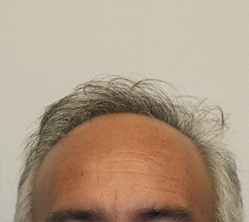 hair transplant photos