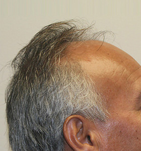 hair transplant photos