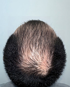 hair transplant photos