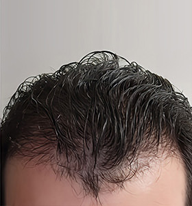 hair transplant photos