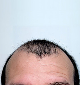 hair transplant photos