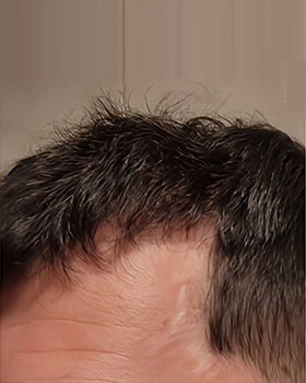 hair transplant photos