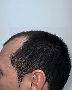 hair transplant photos