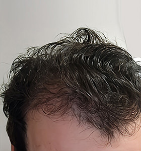 hair transplant photos