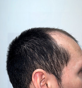 hair transplant photos