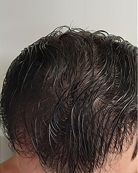 hair transplant photos