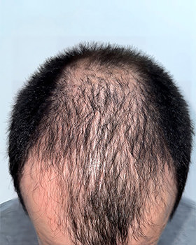 hair transplant photos